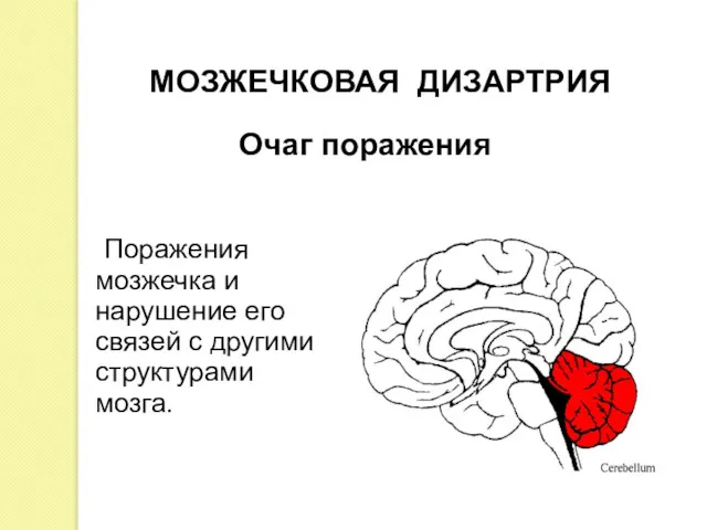 Поражения мозжечка и нарушение его связей с другими структурами мозга. МОЗЖЕЧКОВАЯ ДИЗАРТРИЯ Очаг поражения