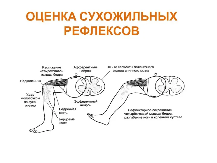 ОЦЕНКА СУХОЖИЛЬНЫХ РЕФЛЕКСОВ