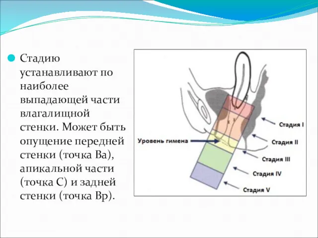 Стадию устанавливают по наиболее выпадающей части влагалищной стенки. Может быть