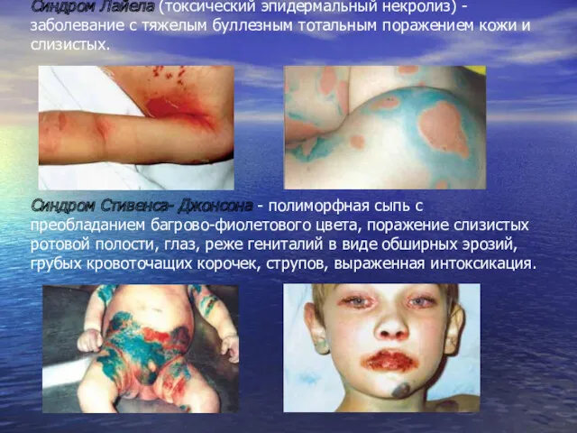 Синдром Лайела (токсический эпидермальный некролиз) - заболевание с тяжелым буллезным тотальным поражением кожи