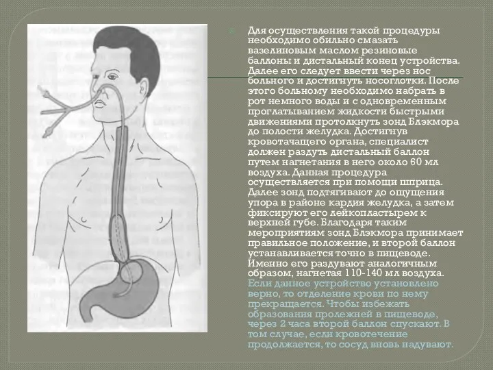 Для осуществления такой процедуры необходимо обильно смазать вазелиновым маслом резиновые баллоны и дистальный