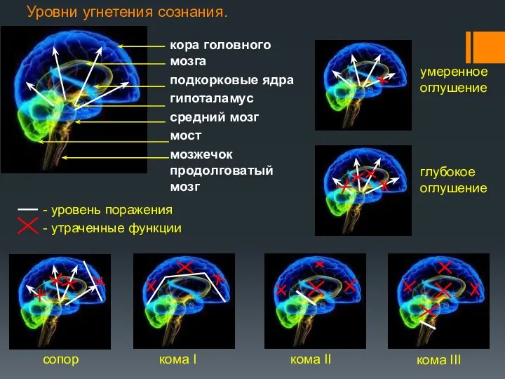 Уровни угнетения сознания. кора головного мозга подкорковые ядра гипоталамус средний