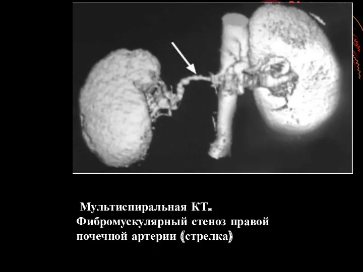 Мультиспиральная КТ. Фибромускулярный стеноз правой почечной артерии (стрелка)