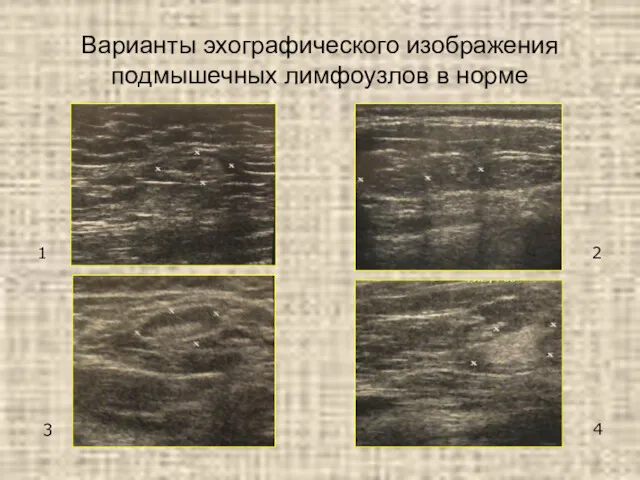 Варианты эхографического изображения подмышечных лимфоузлов в норме 1 2 3 4