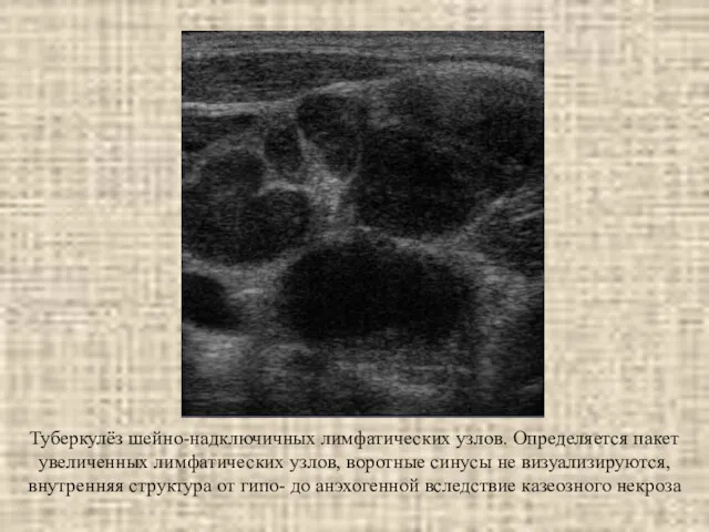 Туберкулёз шейно-надключичных лимфатических узлов. Определяется пакет увеличенных лимфатических узлов, воротные