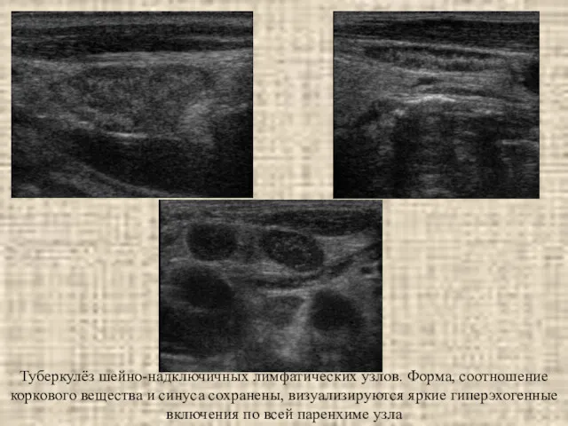 Туберкулёз шейно-надключичных лимфатических узлов. Форма, соотношение коркового вещества и синуса