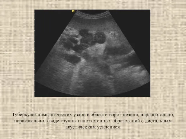 Туберкулёз лимфатических узлов в области ворот печени, парааортально, паракавально в