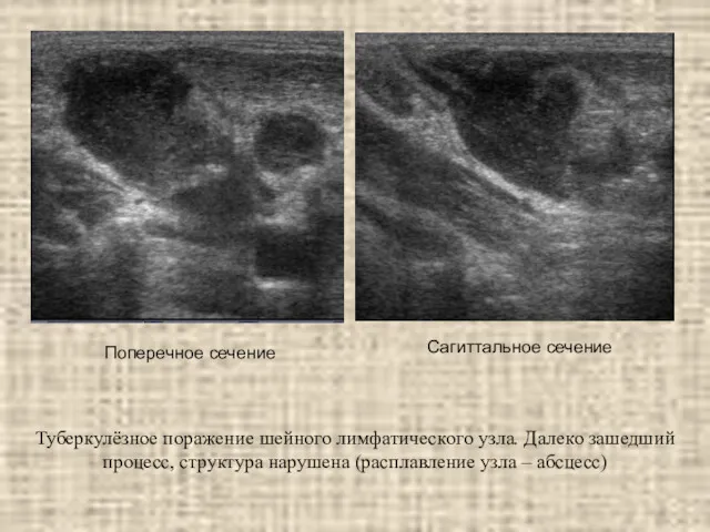 Туберкулёзное поражение шейного лимфатического узла. Далеко зашедший процесс, структура нарушена