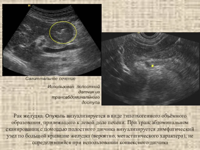 Рак желудка. Опухоль визуализируется в виде гипоэхогенного объёмного образования, прилежащего