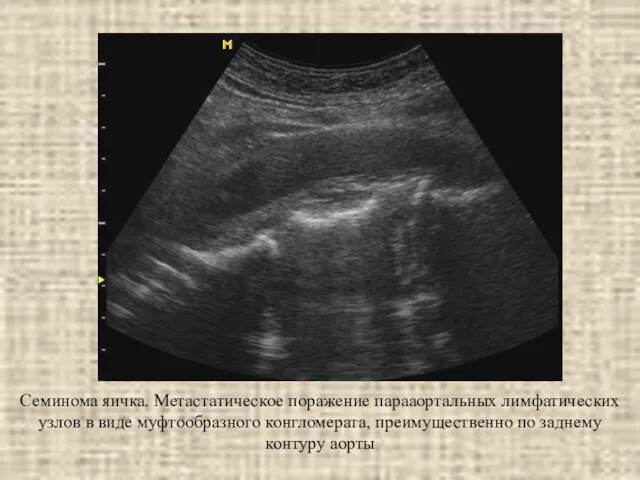 Семинома яичка. Метастатическое поражение парааортальных лимфатических узлов в виде муфтообразного конгломерата, преимущественно по заднему контуру аорты