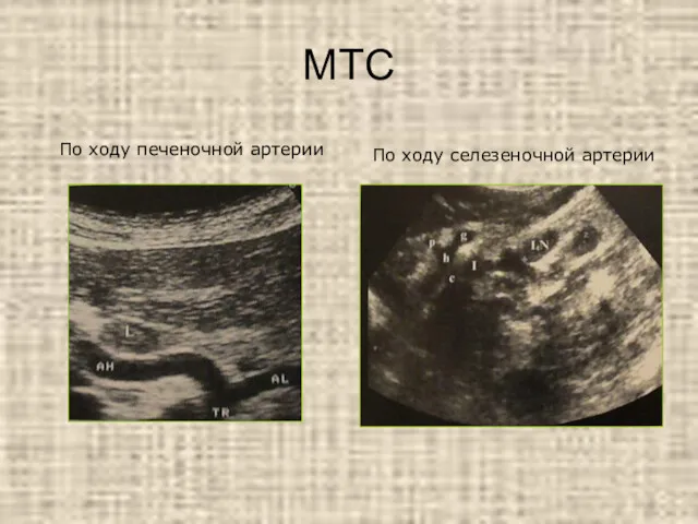 МТС По ходу селезеночной артерии По ходу печеночной артерии