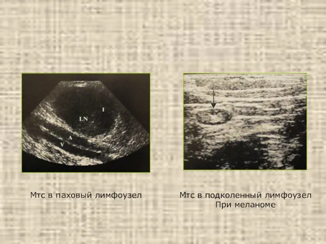 Мтс в паховый лимфоузел Мтс в подколенный лимфоузел При меланоме