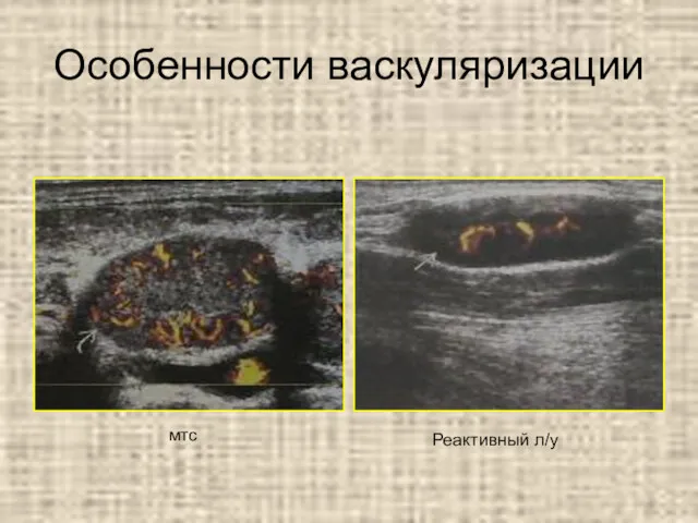 Особенности васкуляризации Реактивный л/у мтс