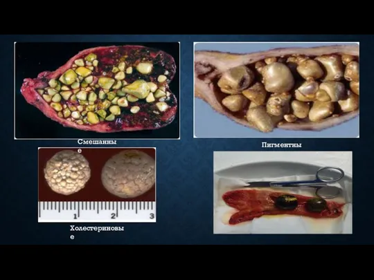 Смешанные Холестериновые Пигментные
