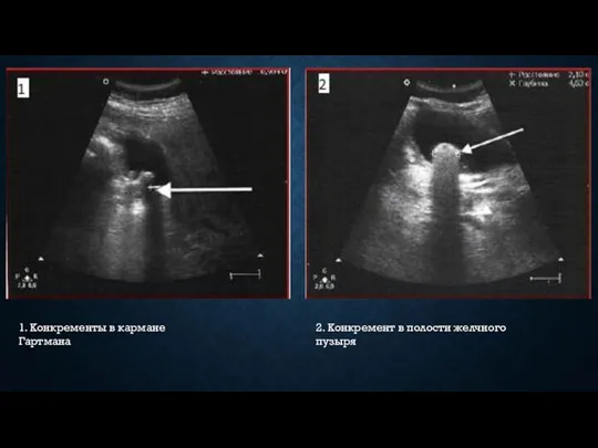 1. Конкременты в кармане Гартмана 2. Конкремент в полости желчного пузыря
