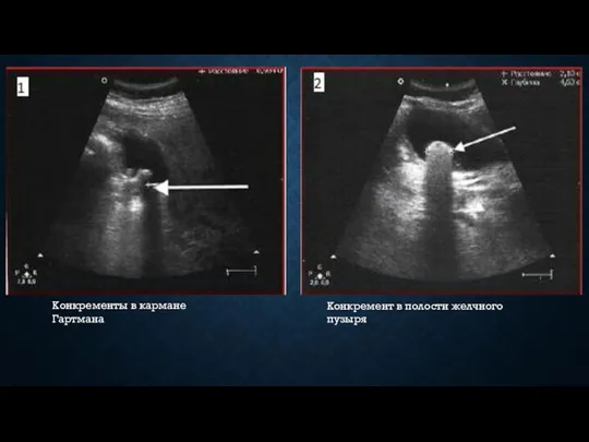 Конкременты в кармане Гартмана Конкремент в полости желчного пузыря
