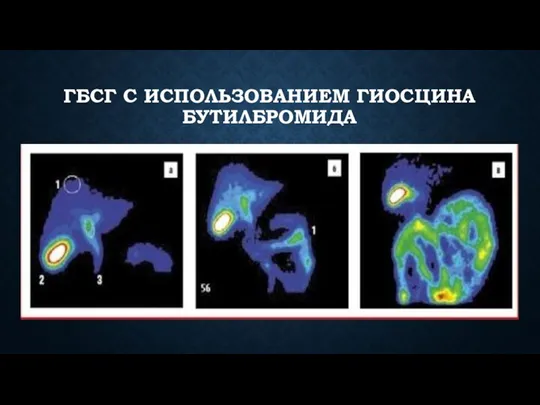 ГБСГ С ИСПОЛЬЗОВАНИЕМ ГИОСЦИНА БУТИЛБРОМИДА