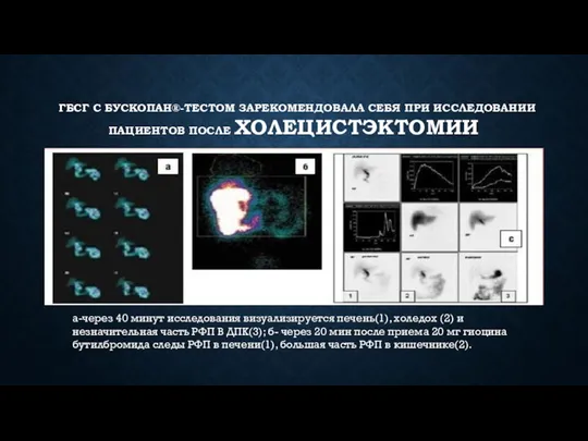 ГБСГ С БУСКОПАН®-ТЕСТОМ ЗАРЕКОМЕНДОВАЛА СЕБЯ ПРИ ИССЛЕДОВАНИИ ПАЦИЕНТОВ ПОСЛЕ ХОЛЕЦИСТЭКТОМИИ а-через 40 минут