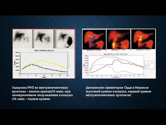 Задержка РФП во внутрипеченочных протоках - желтая кривая(54 мин), при своевременном опорожнении холедоха