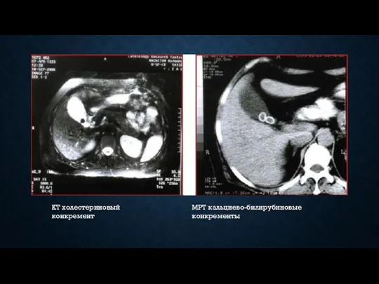 КТ холестериновый конкремент МРТ кальциево-билирубиновые конкременты