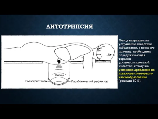 ЛИТОТРИПСИЯ Метод направлен на устранение следствия заболевания, а не на