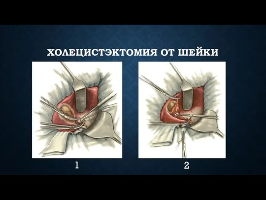 ХОЛЕЦИСТЭКТОМИЯ ОТ ШЕЙКИ 1 2