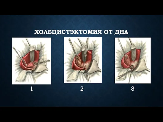 ХОЛЕЦИСТЭКТОМИЯ ОТ ДНА 1 2 3