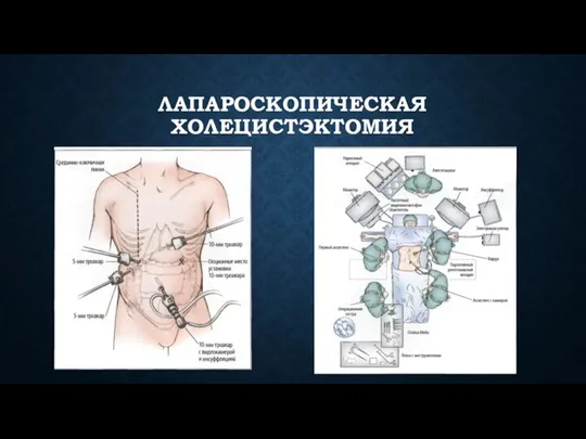 ЛАПАРОСКОПИЧЕСКАЯ ХОЛЕЦИСТЭКТОМИЯ