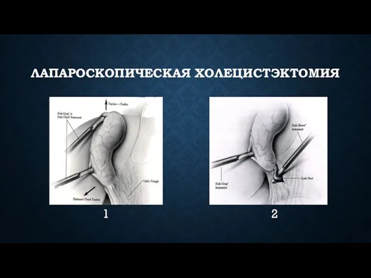 ЛАПАРОСКОПИЧЕСКАЯ ХОЛЕЦИСТЭКТОМИЯ 1 2