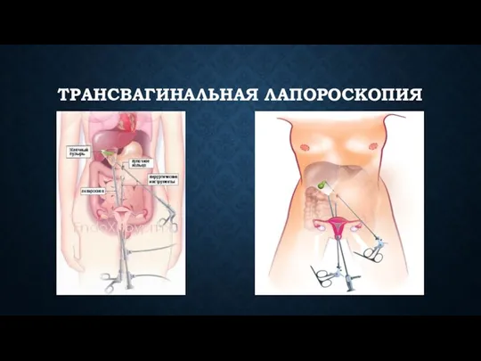 ТРАНСВАГИНАЛЬНАЯ ЛАПОРОСКОПИЯ