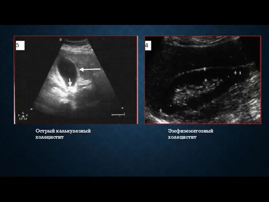 Острый калькулезный холецистит Эмфизематозный холецистит