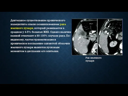 Длительное существование хронического холецистита опасно возникновением рака желчного пузыря, который развивается в среднем