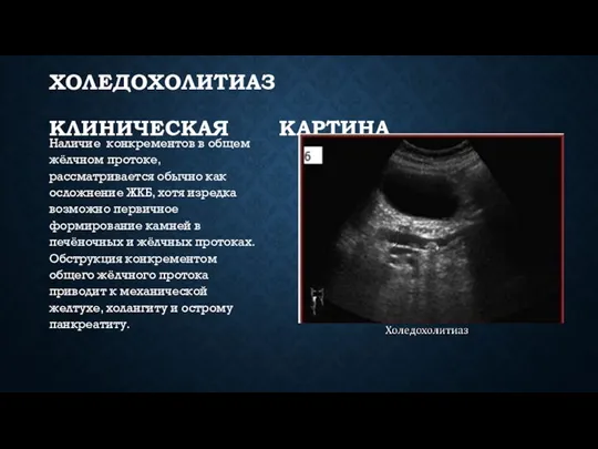 ХОЛЕДОХОЛИТИАЗ КЛИНИЧЕСКАЯ КАРТИНА Наличие конкрементов в общем жёлчном протоке, рассматривается