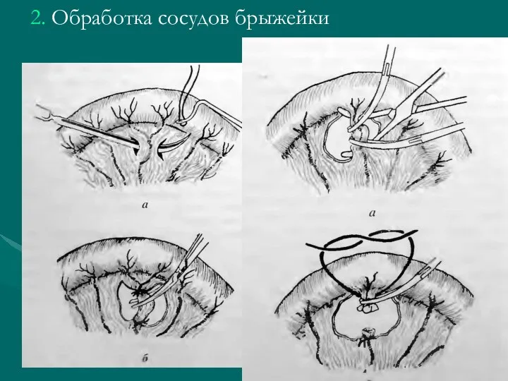 2. Обработка сосудов брыжейки