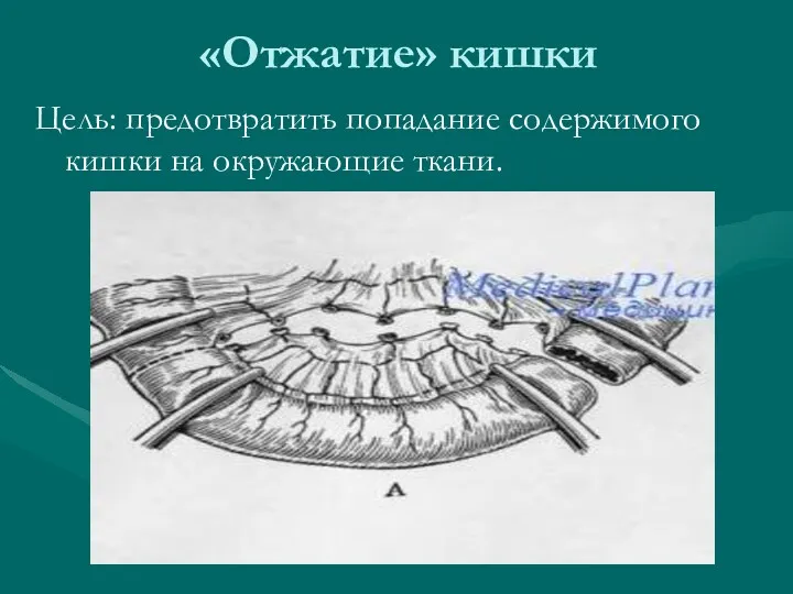 «Отжатие» кишки Цель: предотвратить попадание содержимого кишки на окружающие ткани.