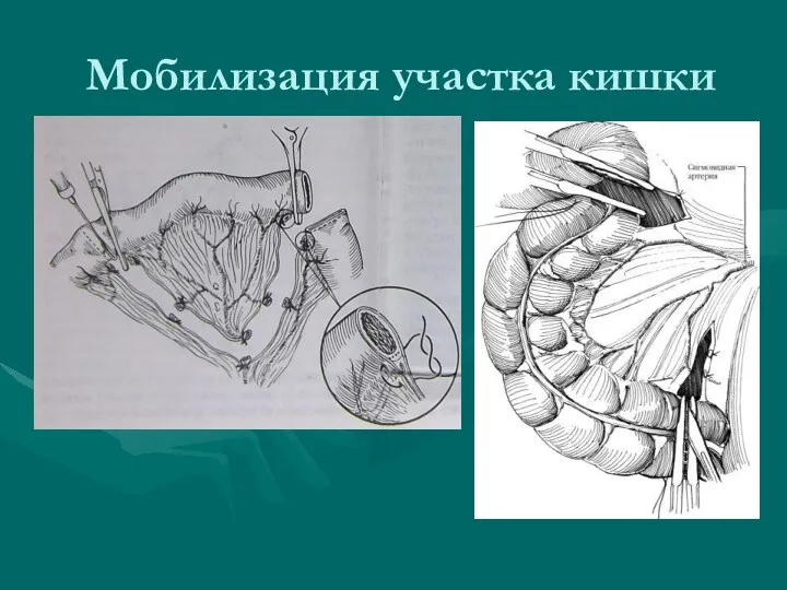 Мобилизация участка кишки