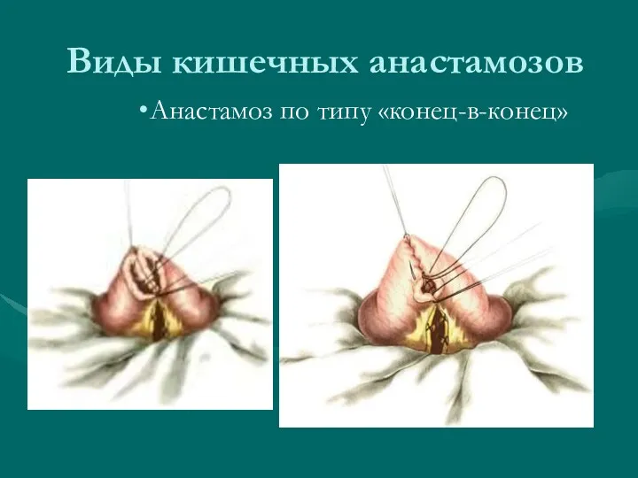 Виды кишечных анастамозов Анастамоз по типу «конец-в-конец»