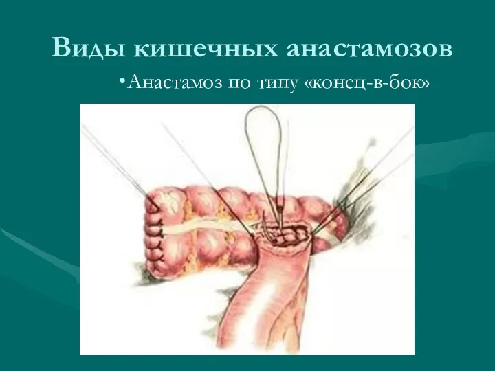 Виды кишечных анастамозов Анастамоз по типу «конец-в-бок»