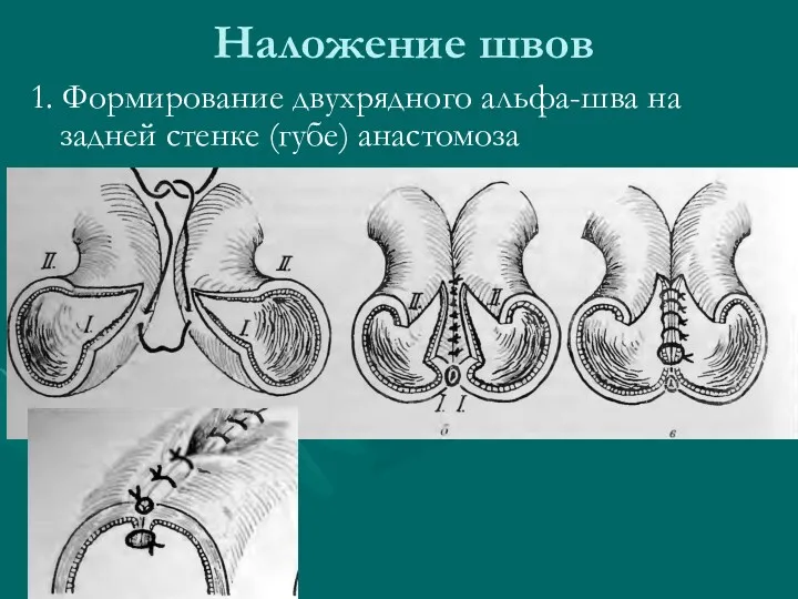 Наложение швов 1. Формирование двухрядного альфа-шва на задней стенке (губе) анастомоза