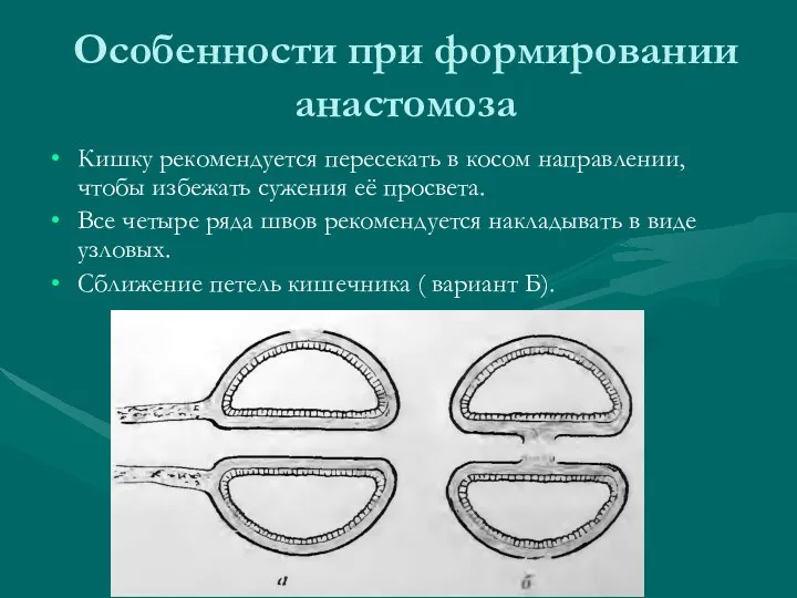 Особенности при формировании анастомоза Кишку рекомендуется пересекать в косом направлении,