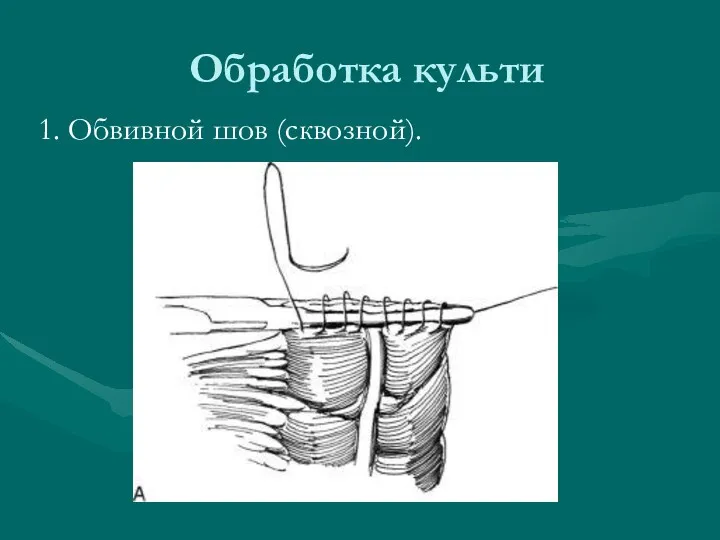 Обработка культи 1. Обвивной шов (сквозной).