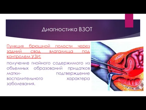 Пункция брюшной полости через задний свод влагалища под контролем УЗИ: