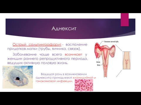 Аднексит Острый сальпингоофорит - воспаление придатков матки (трубы, яичника, связок).