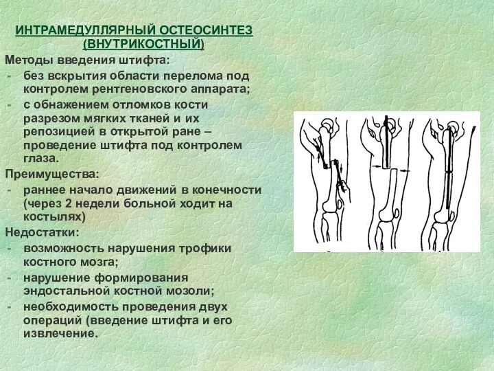 ИНТРАМЕДУЛЛЯРНЫЙ ОСТЕОСИНТЕЗ (ВНУТРИКОСТНЫЙ) Методы введения штифта: без вскрытия области перелома