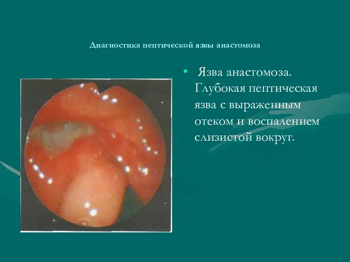 Диагностика пептической язвы анастомоза Язва анастомоза. Глубокая пептическая язва с выраженным отеком и воспалением слизистой вокруг.