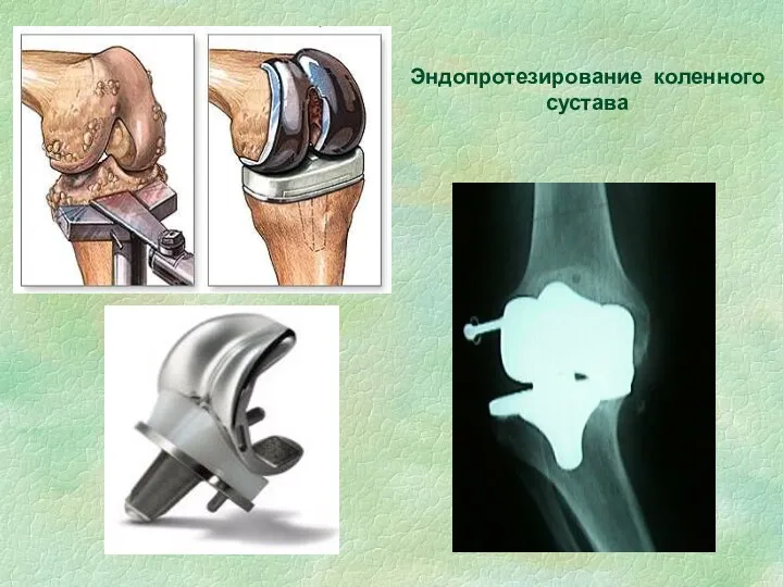 Эндопротезирование коленного сустава