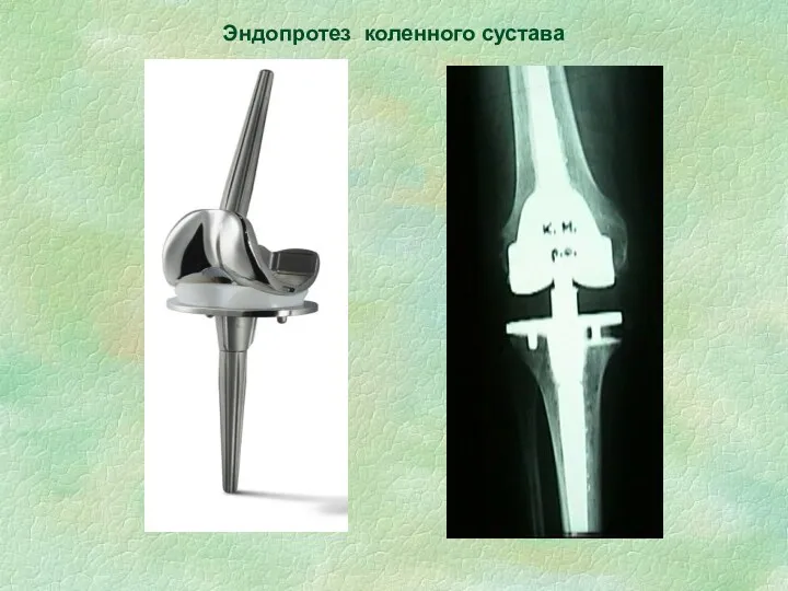 Эндопротез коленного сустава