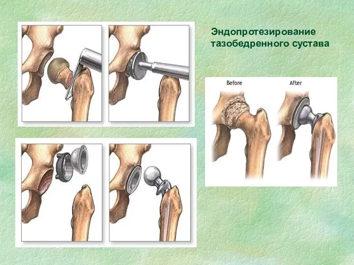 Эндопротезирование тазобедренного сустава