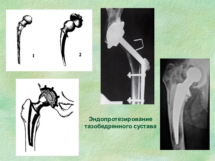 Эндопротезирование тазобедренного сустава