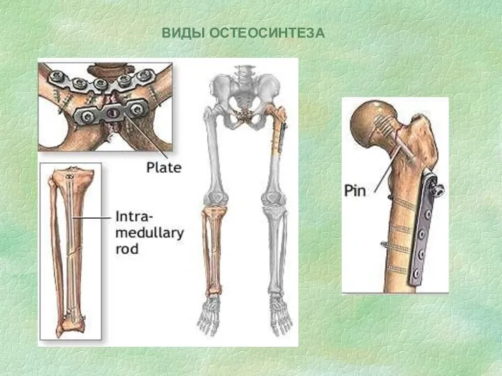 ВИДЫ ОСТЕОСИНТЕЗА